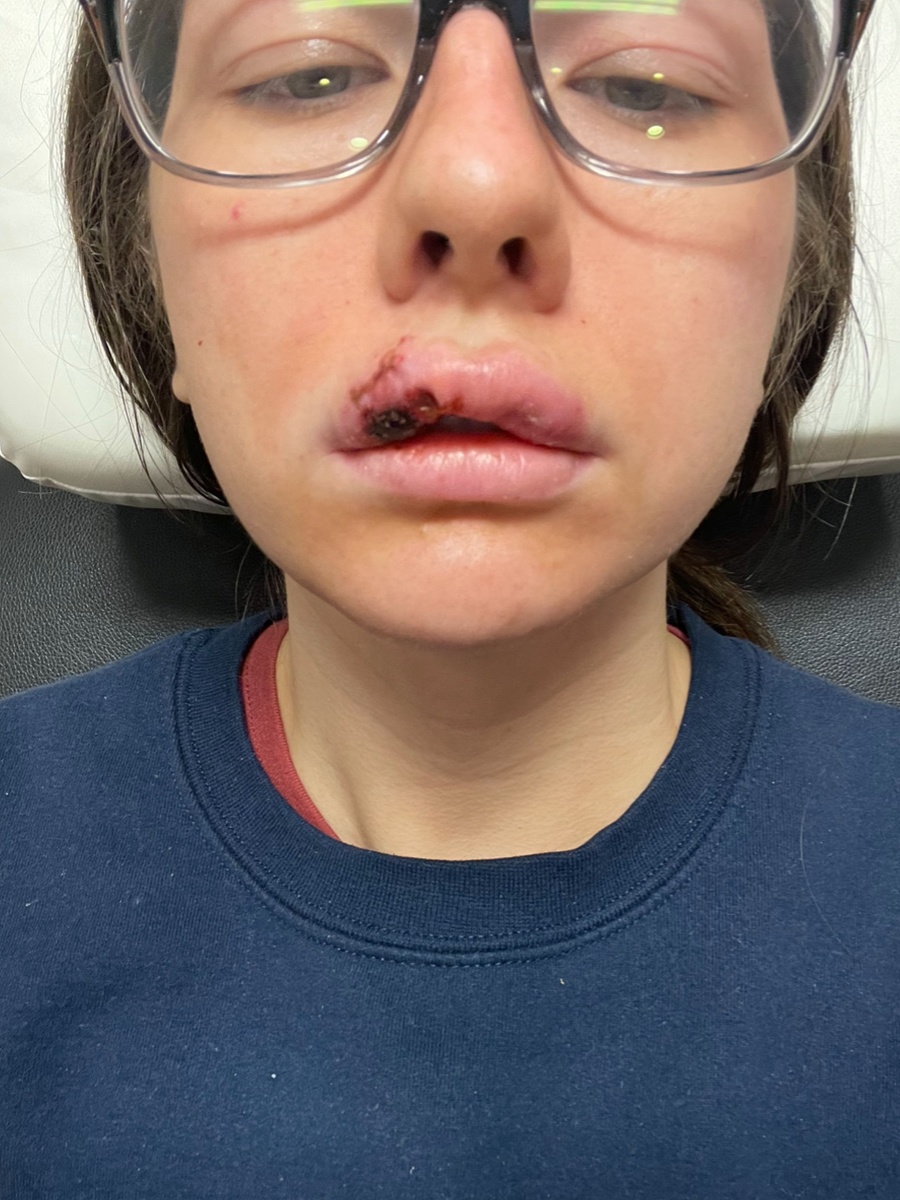 Paige Bellingerová takmer prišla o polovicu tváre.