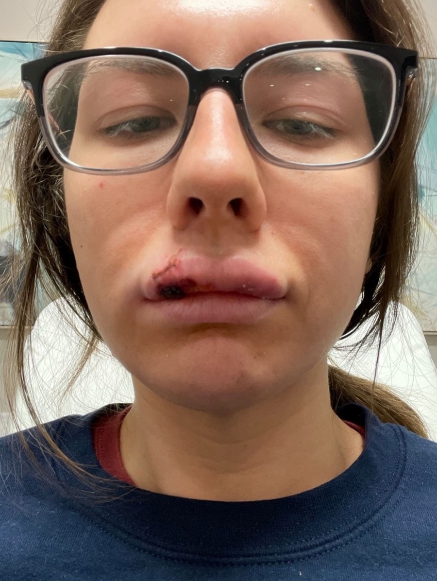 Paige Bellingerová takmer prišla o polovicu tváre.
