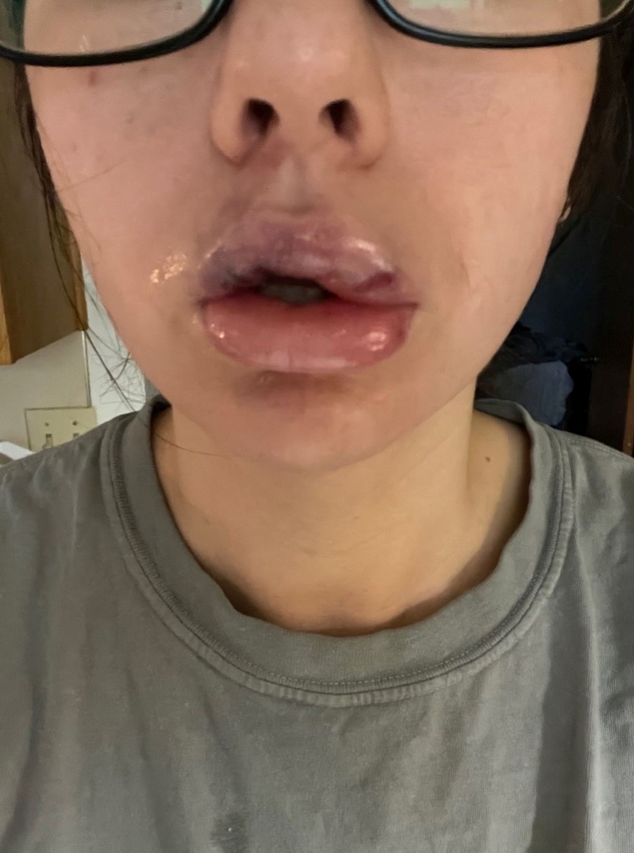 Paige Bellingerová takmer prišla o polovicu tváre.