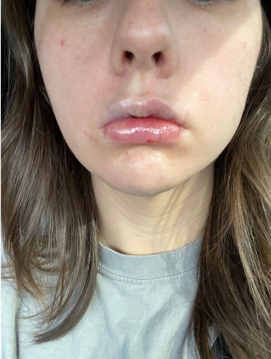 Paige Bellingerová takmer prišla o polovicu tváre.