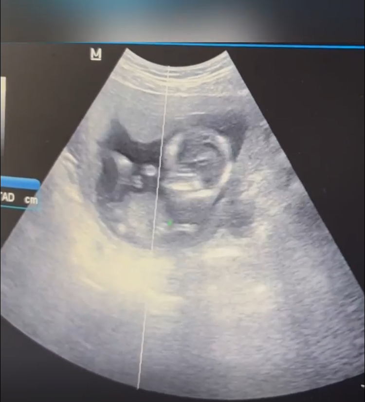 Dvojica sa pochválila ultrazvukom.