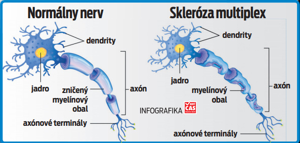 Normálny nerv vs, Skleróza