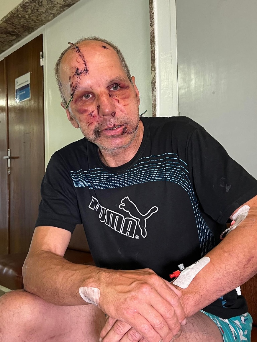 Marián (58) utrpel veľké zranenia po útoku medvedice.