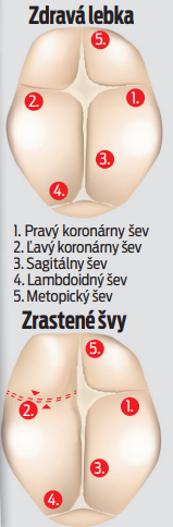 Kraniosynostóza