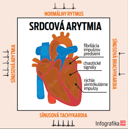 Srdcová arytmia
