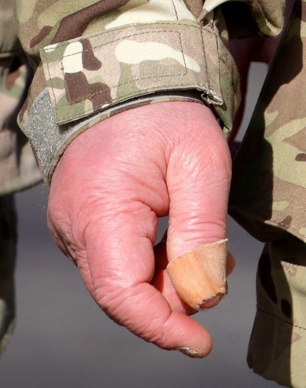Opuchnutie prstov môže spôsobovať mnoho ochorení.