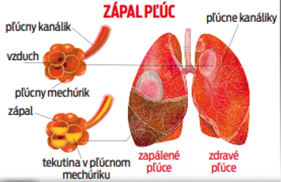 Zápal pľúc