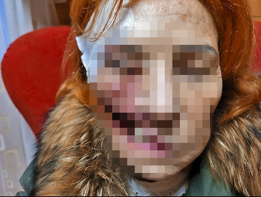 Nešťastná žena stráca tkanivo a napadnutú má aj takmer polovicu tváre.