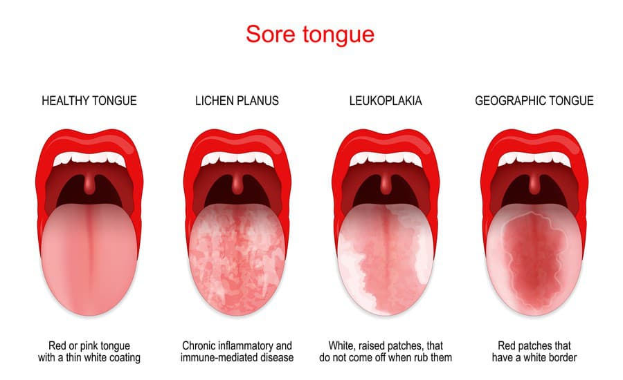 Sore or white tongue. comparison of healthy tongue and oral disease: Lichen planus, Leukoplakia, Geographic tongue. Vector poster for medical use