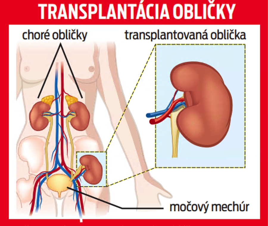 Transplantácia obličky