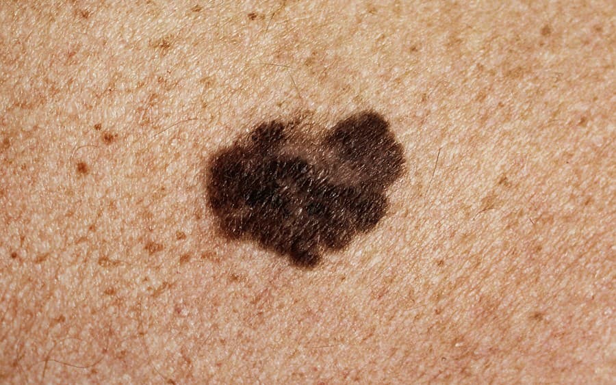 Rakovina kože (ilustračné foto)