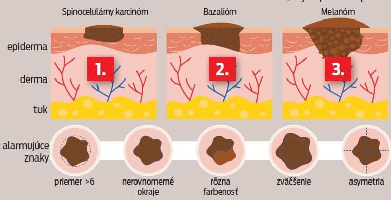 Najčastejšie druhy rakoviny kože.