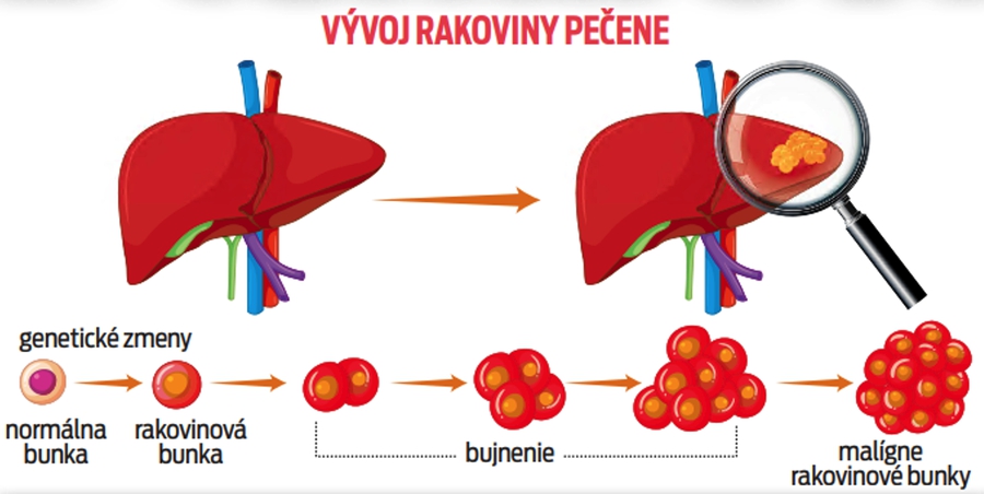 Vývoj rakoviny pečene