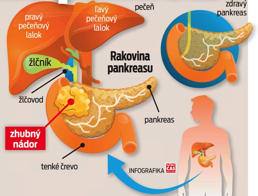 Rakovina pankreasu