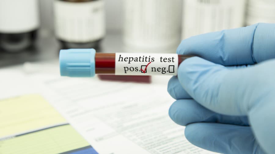 Hepatitída sa rozšírila medzi