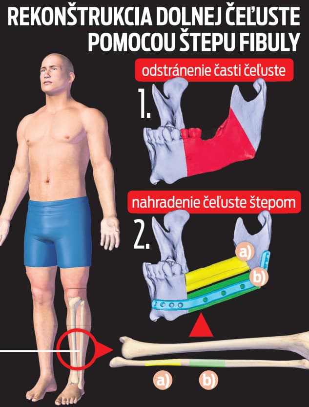 Rekonštrukcia dolnej čeľuste pomocou