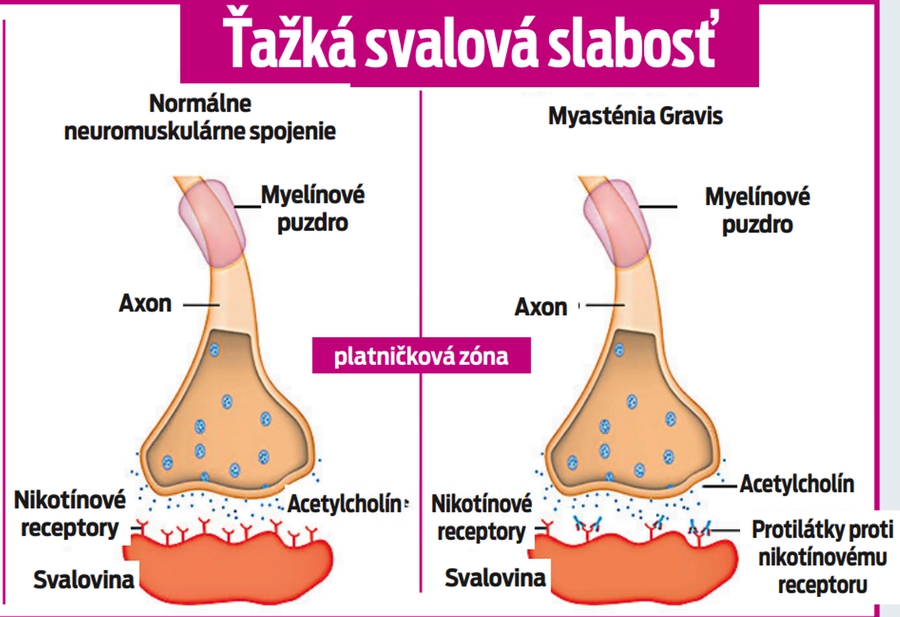 Ťažká svalová slabosť