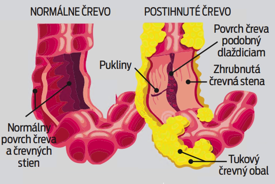 Čo je Crohnova choroba