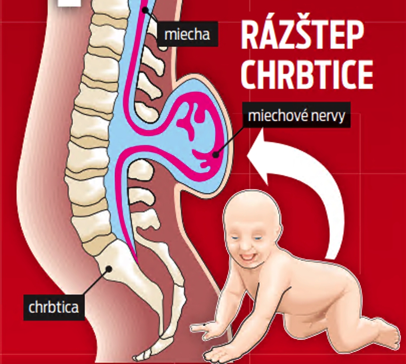 Rázštep chrbtice