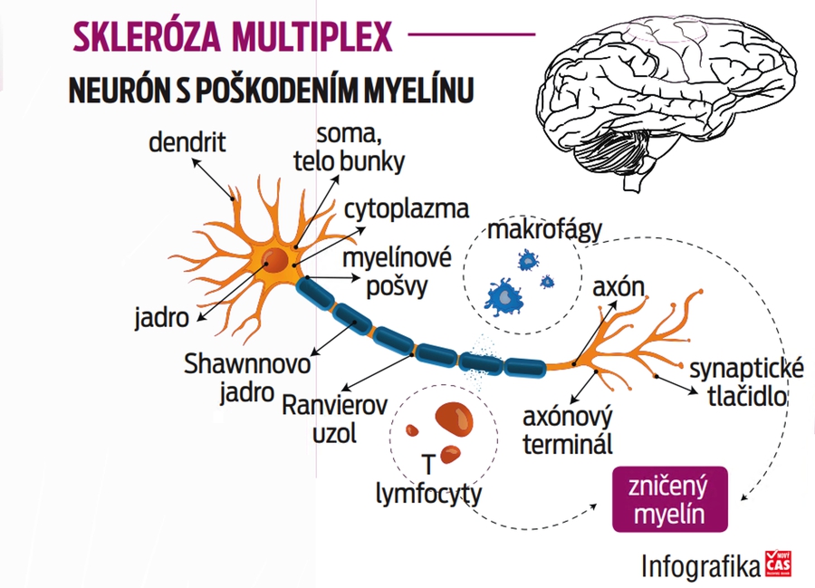 Skleróza multiplex