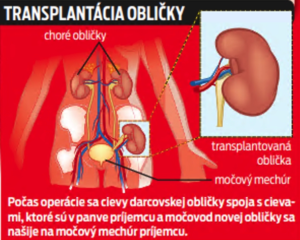 Transplantácia obličky