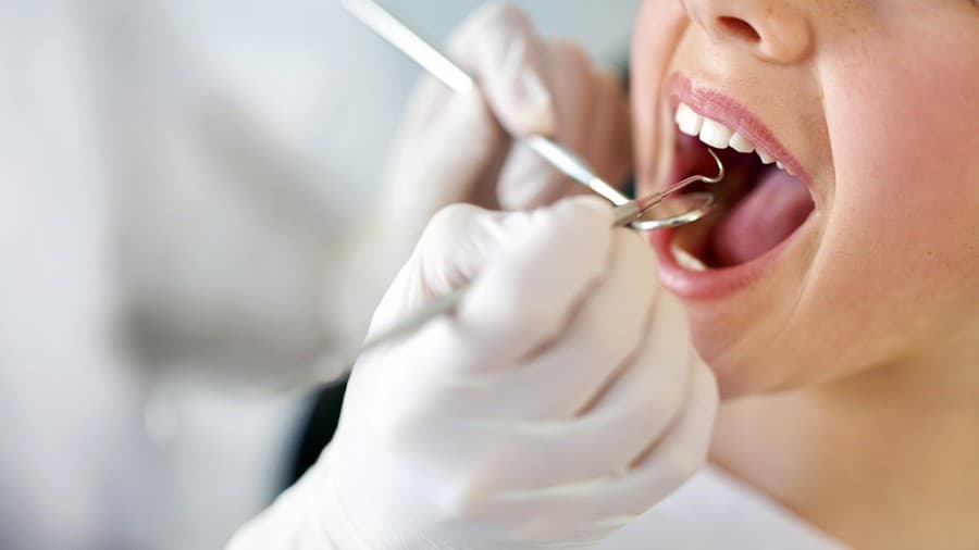 Zubný kameň – stvrdnutý