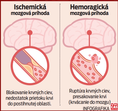 Najčastejšia príčina smrti