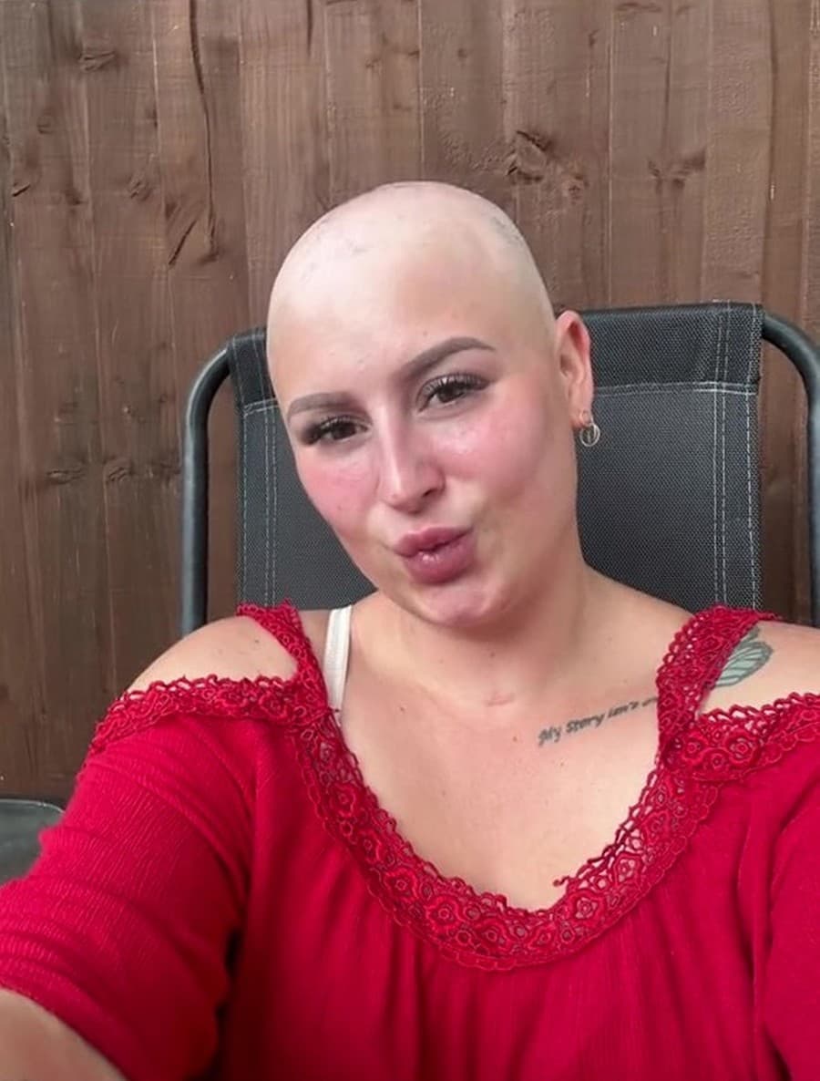 Prišla o všetky vlasy a kožu na končatinách