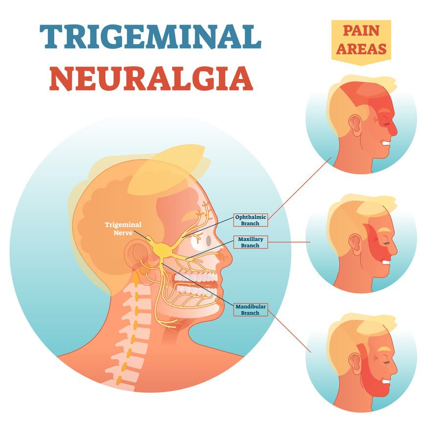 Neuralgia trojklanného nervu a miesta, ktoré ochorenie postihuje.