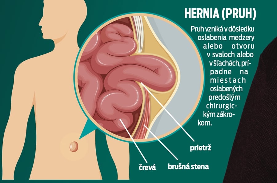 Hernia (Pruh)