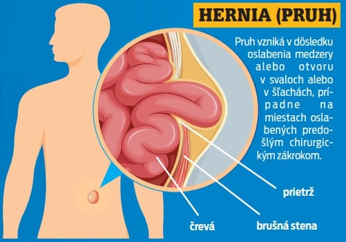 Hernia (pruh)