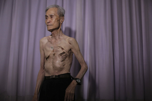 Sumiteru Taniguchi je jedným z tých ľudí, ktorým sa podarilo prežiť ničivý výbuch jadrovej bomby v Nagasaki v roku 1945. 