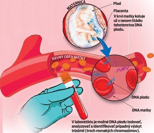 V laboratóriu je možné DNA plodu izolovať, analyzovať a identifi kovať prípadný výskyt trizómií (troch rovnakých chromozómov).