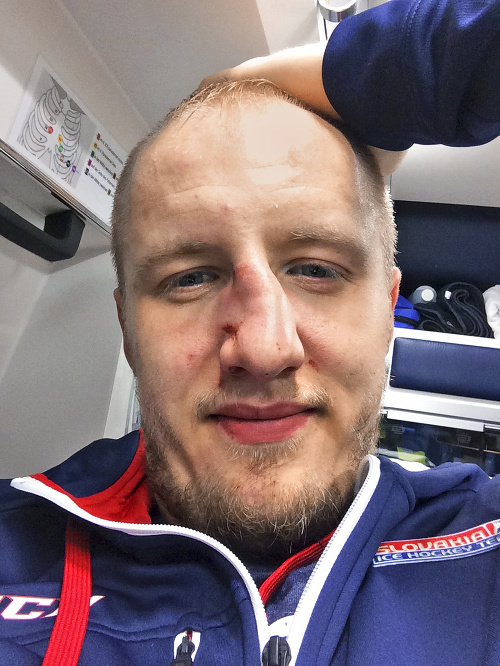 Napravený nos: Radovan neváhala poslal foto zraneného nosa po ošetrení.