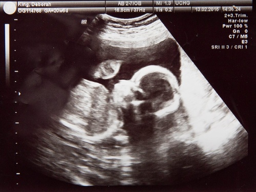 Britke sa na ultrazvuku bábätka zjavilo niečo, čo jej pripomína tvár babky.