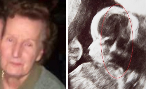 Britke sa na ultrazvuku bábätka zjavilo niečo, čo jej pripomína tvár babky.