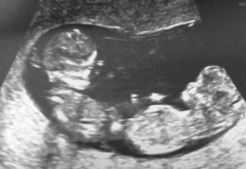 Ultrazvuk ukázal, že Michelle čaká dvojičky rovno dve.