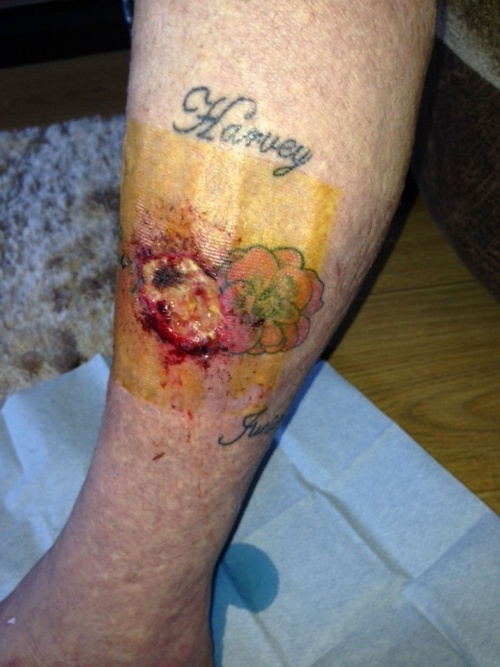 Na mieste tetovania sa objavila obrovská hnisavá rana.