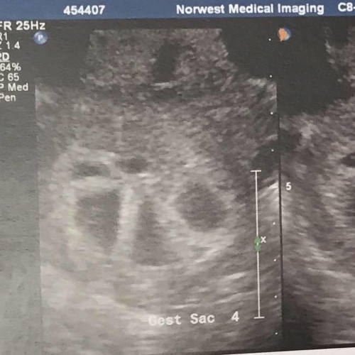 Z ultrazvuku bola v šoku. 