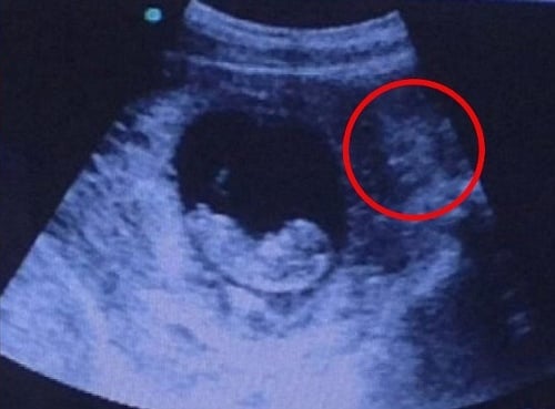 Vidíte zvláštny obraz na ultrazvuku?