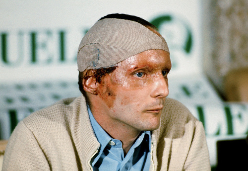 September 1976: Niki na tlačovke predstúpil pred novinárov s popáleninami tváre. 
