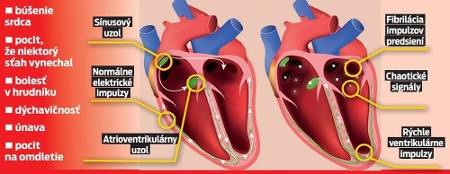 Príznaky srdcovej arytmie.