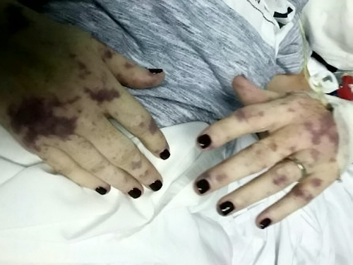 Ruky jej pokryli fialové škvrny.