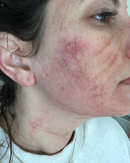 Dermatológ jej povedal, že má na tvári popáleniny od chemikálií