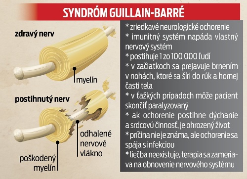 Syndróm Guillain-Barré