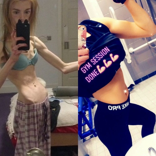 Annie počas anorexii a po nej. Rozdiel je viditeľný.