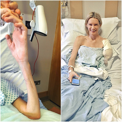 Po hororovej nehode mala dablérka tak poškodenú ruku, že jej ju museli amputovať.