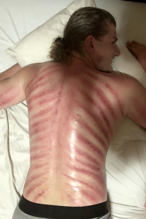 Takto vyzeral Austrálčanov chrbát po procedúre.