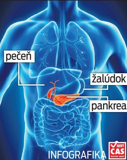 Rakovina pankreasu