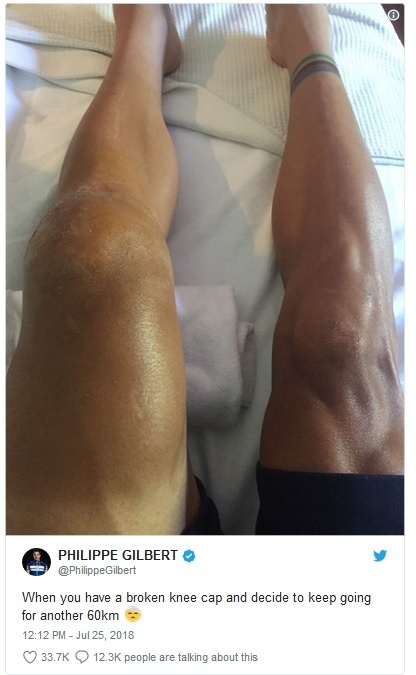 Gilbert dal na svoj twitter fotografiu svojho opuchnutého kolena. 